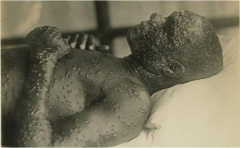 Paciente de varíola no fim do século XIX - National Museum of Health & Medicine