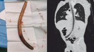 ATAQUES MENTAIS: Homem é operado após engolir pedaço de madeira de 30cm seguindo ordem de ‘vozes na cabeça’